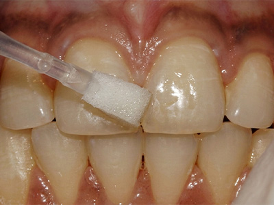 Suezaki Family Dentistry | Fluoride Treatment, Veneers and Dental Fillings