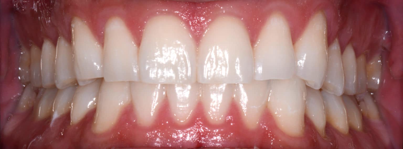 The image shows a close-up view of a person s teeth with a focus on a large gap between the front teeth, which are discolored, and a red gumline.