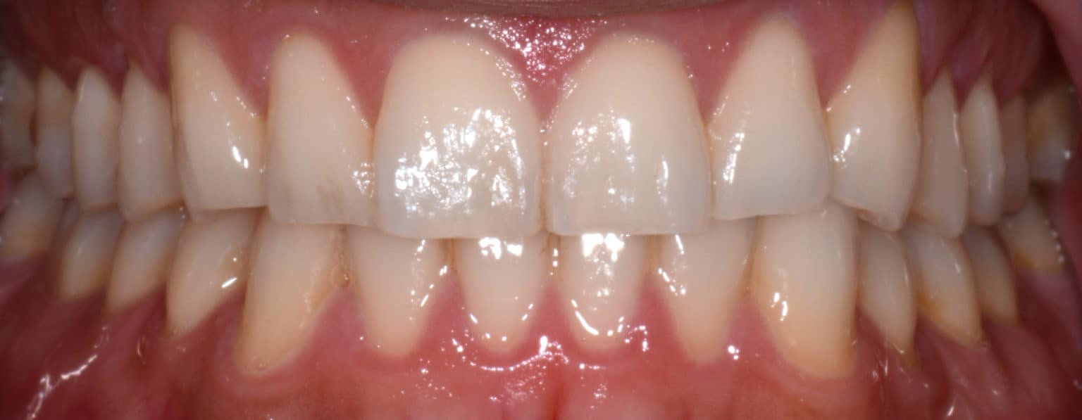 The image shows a close-up view of a person s teeth with an overbite, featuring white fillings and a pinkish gumline.