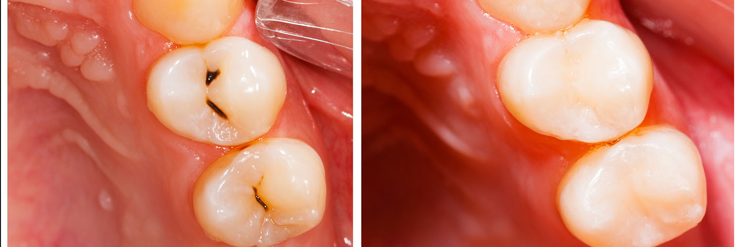 The image displays a close-up view of a section of teeth with visible cavities, showcasing oral health issues.