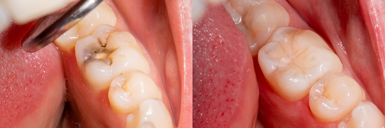 The image displays a close-up view of a dental implant with a screw visible on its side, set against an out-of-focus background featuring a person s mouth partially open, showcasing their teeth.